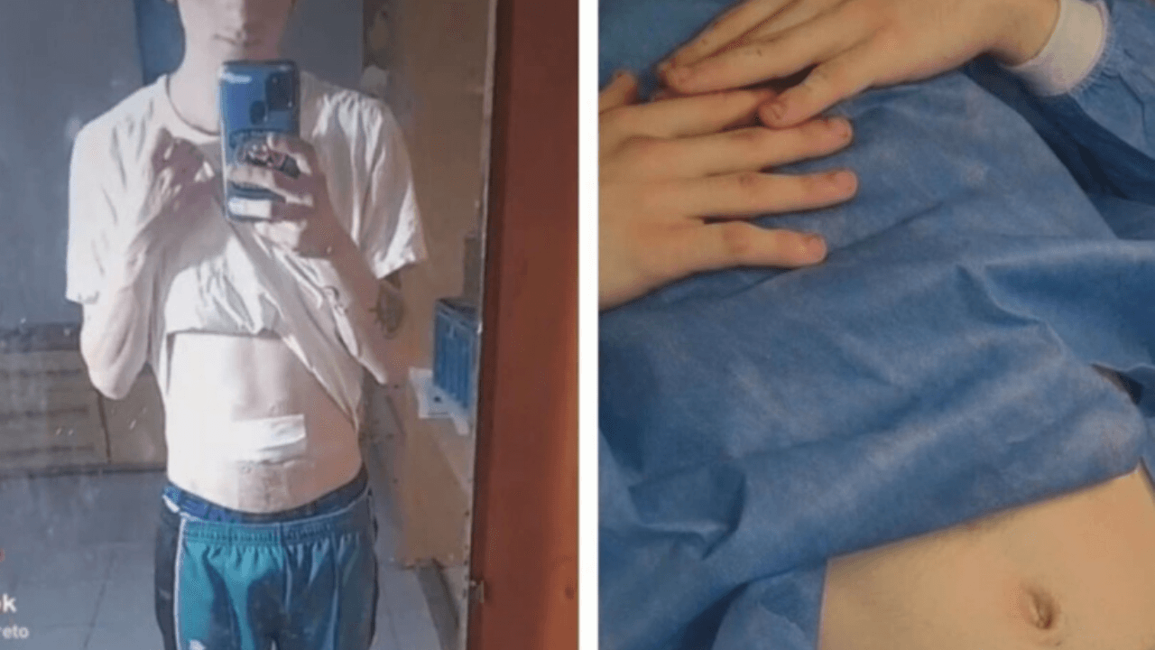 Un joven causó polémica en redes sociales tras compartir un video donde mostró que acudió a quitarse el ombligo para no acumular suciedad