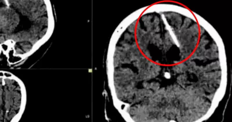 Los doctores detallaron que el objeto estuvo alojado en el cerebro de la abuelita desde su nacimiento.