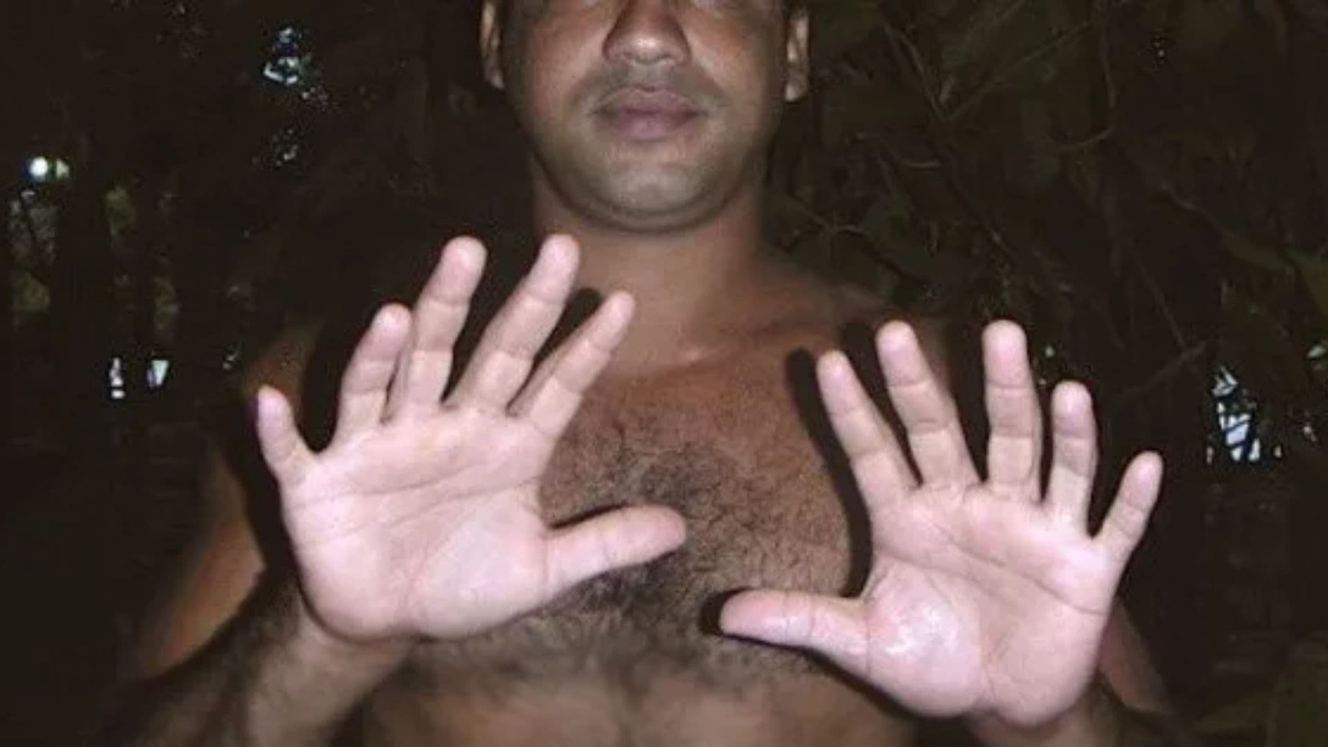 En Cuba se tiene registro del caso de otro hombre que cuenta con 23 dedos. Los dos se conocen y han tenido algunos encuentros amistosos.