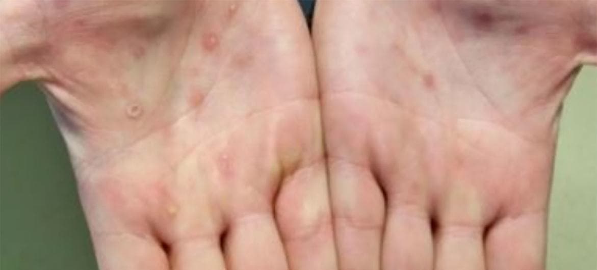 La viruela símica puede propagarse a cualquier persona, la transmisión del virus se encuentra principalmente en una subpoblación definida con las siguientes características: hombres que se identifican como homosexuales, bisexuales u hombres que tienen sex