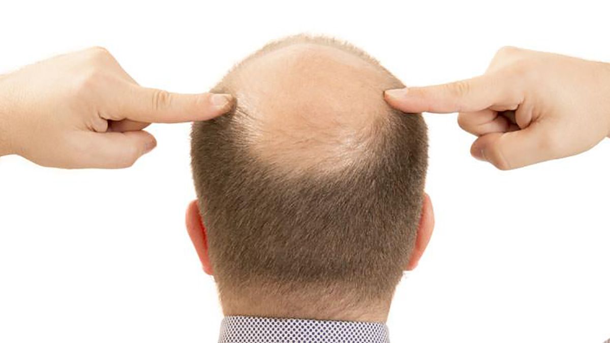 Caída de cabello: Causas y cuidados para la alopecia