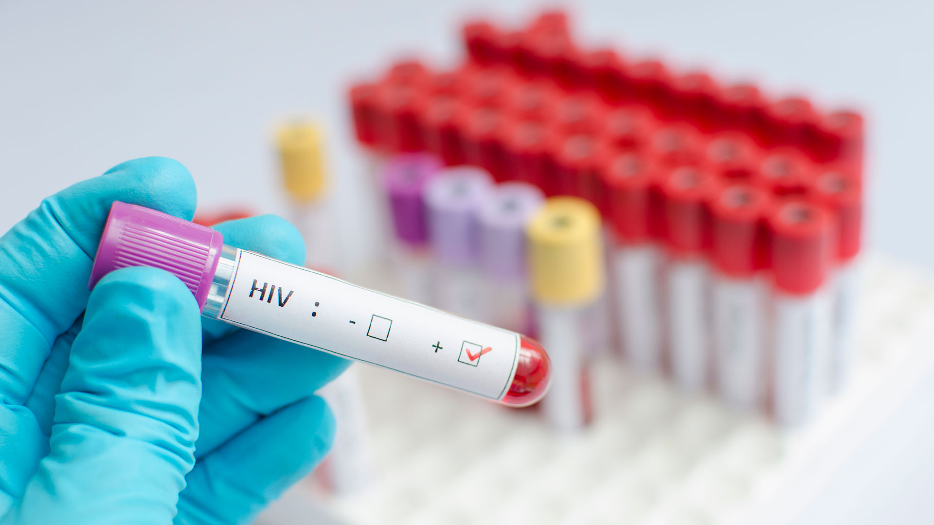 Registran tercer paciente en el mundo en curarse de VIH