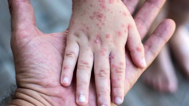 Pensilvania registra dos muertes por sarampión en medio de repunte de contagios en EE.UU.