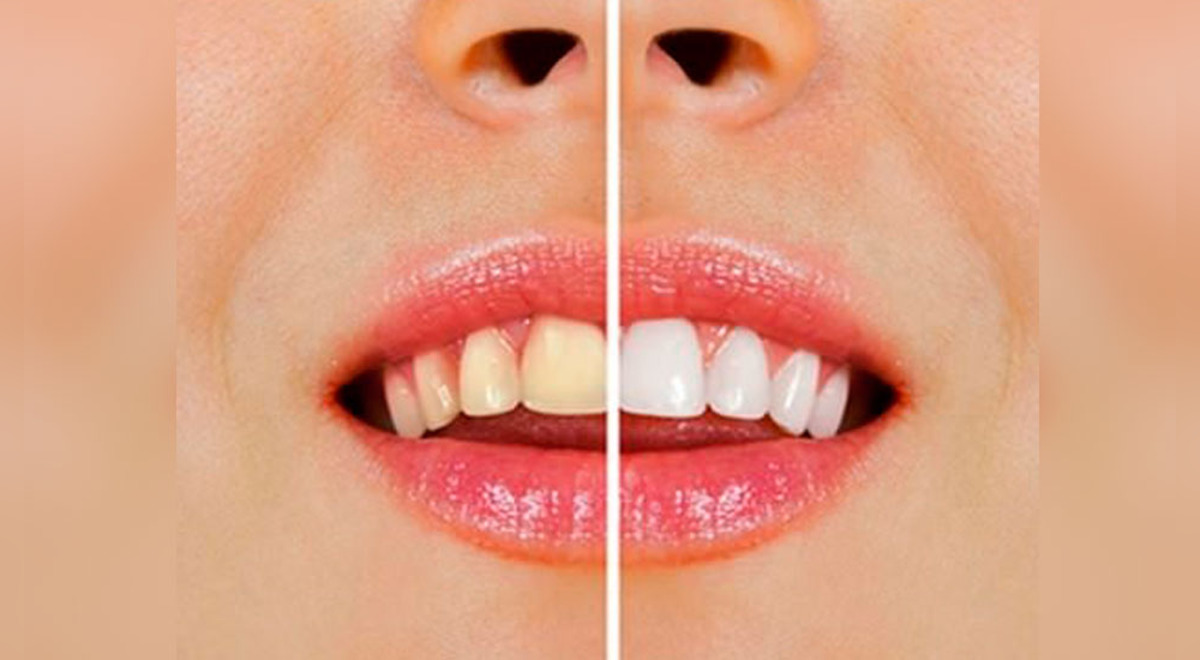 La coloración amarillenta de los dientes puede atribuirse a diversos factores como genética, edad que puede llevar al desgaste del esmalte de los dientes exponiendo la dentina más amarilla, el uso de antibióticos, altos niveles de flúor o alteraciones en 