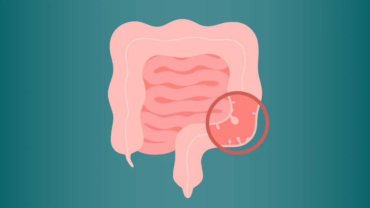 Cáncer de colon: qué es y cómo detectarlo