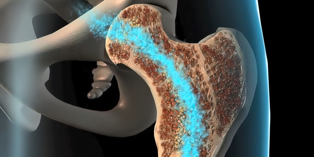 Desafíos de la osteogénesis imperfecta